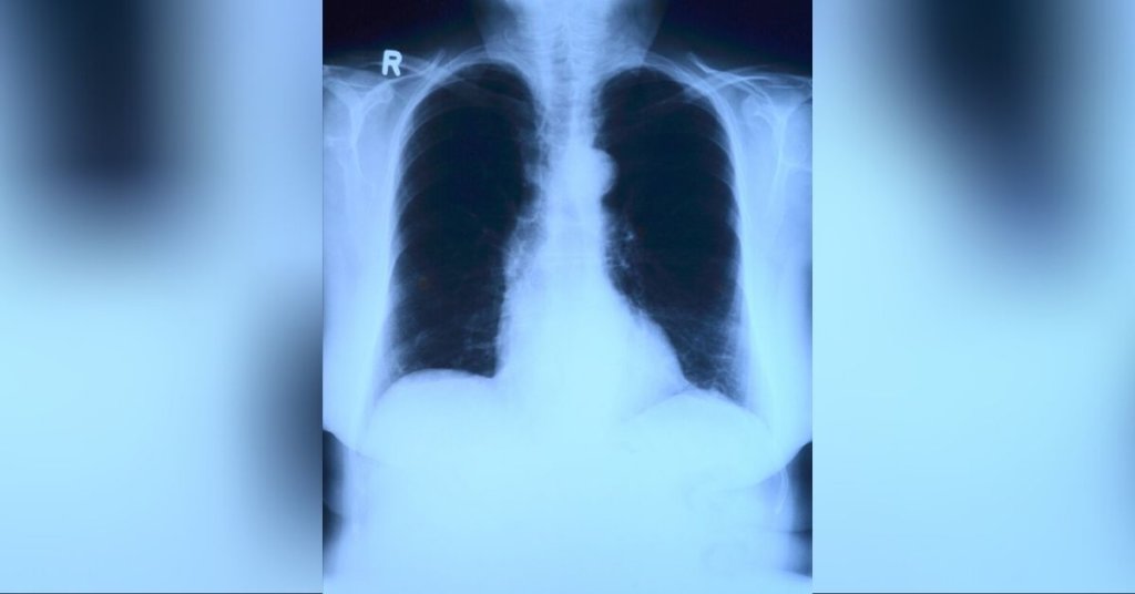 A photo of a lung xray