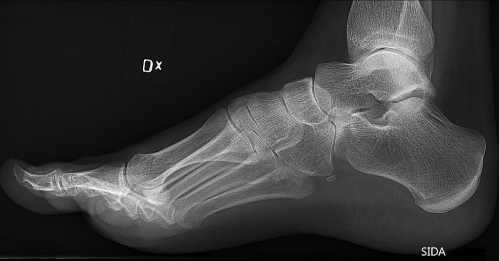 An x-ray of a foot.